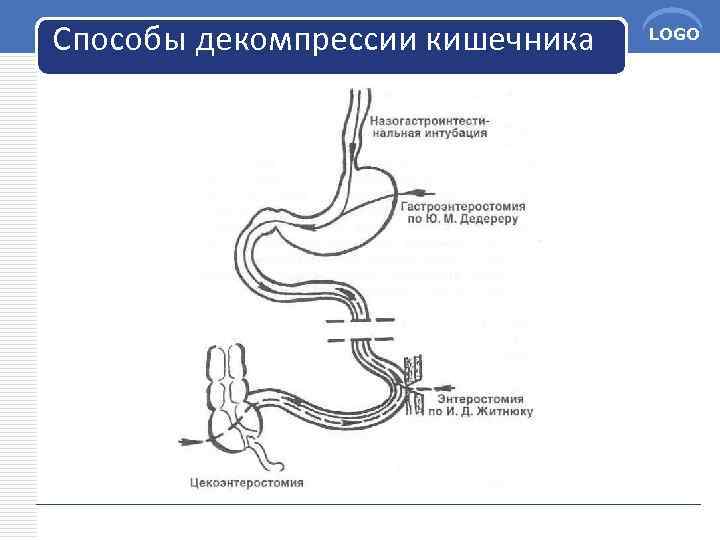 Способы декомпрессии кишечника LOGO 