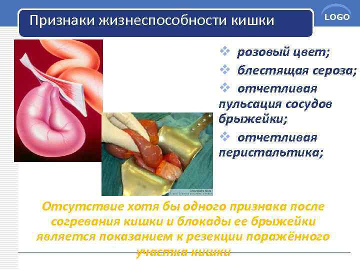 Признаки жизнеспособности кишки LOGO v розовый цвет; v блестящая сероза; v отчетливая пульсация сосудов
