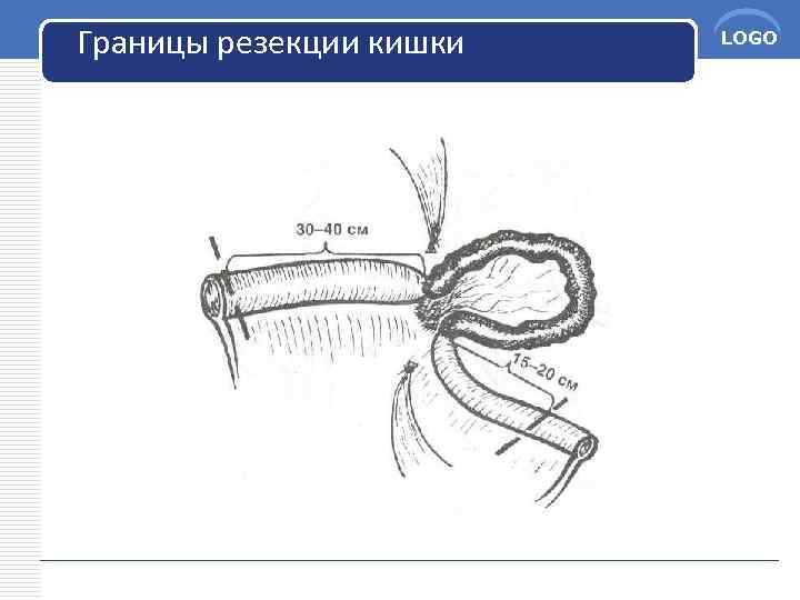 Границы резекции кишки LOGO 
