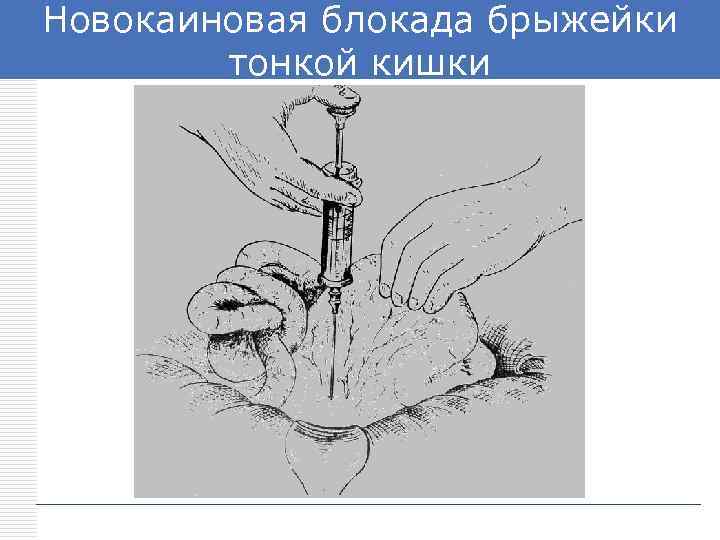 Новокаиновая блокада брыжейки LOGO тонкой кишки 