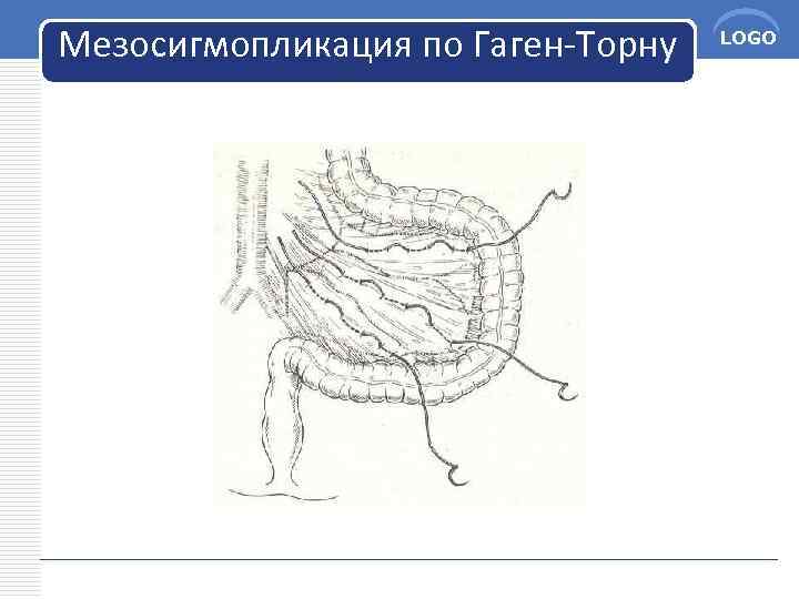 Мезосигмопликация по Гаген-Торну LOGO 