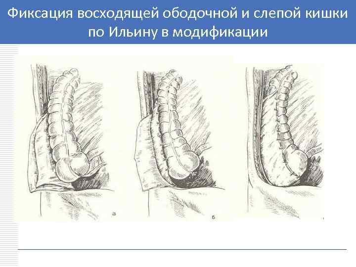 Фиксация восходящей ободочной и слепой кишки LOGO по Ильину в модификации 