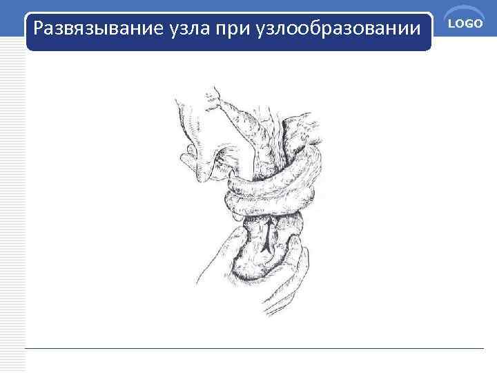 Развязывание узла при узлообразовании LOGO 