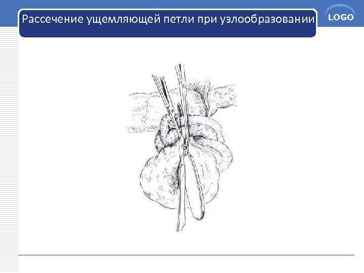 Рассечение ущемляющей петли при узлообразовании LOGO 