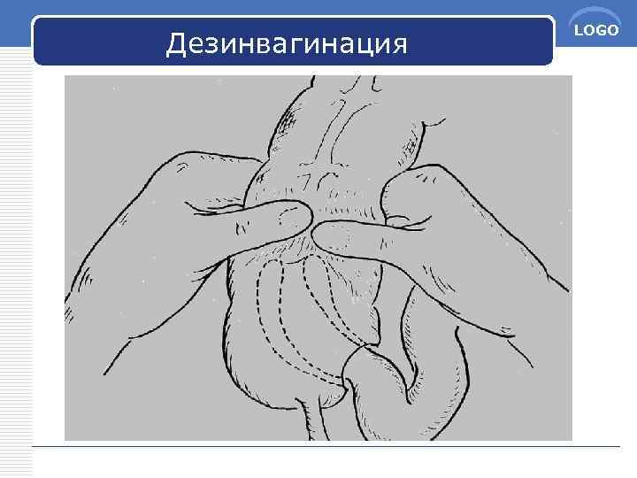 Дезинвагинация LOGO 