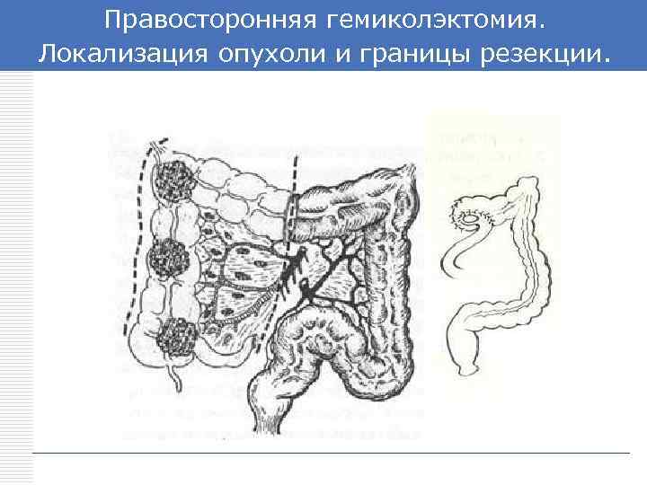 Правосторонняя гемиколэктомия. LOGO Локализация опухоли и границы резекции. 