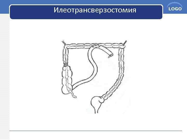 Илеотрансверзостомия LOGO 