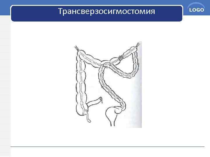 Трансверзосигмостомия LOGO 