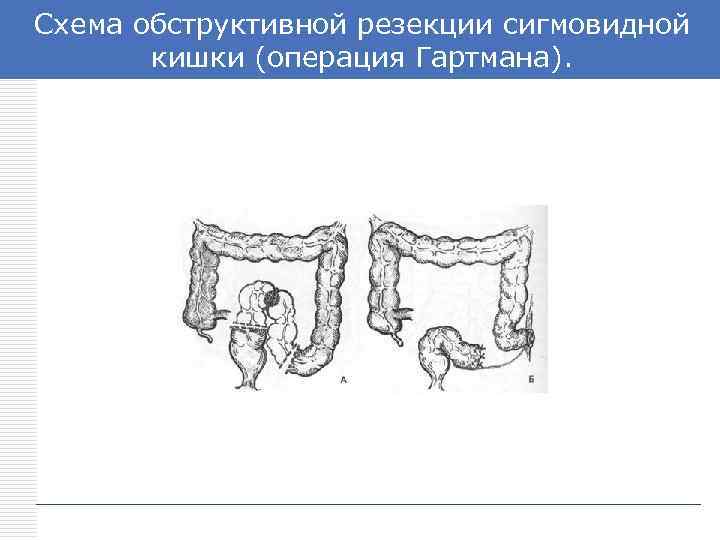 Схема операция гартмана