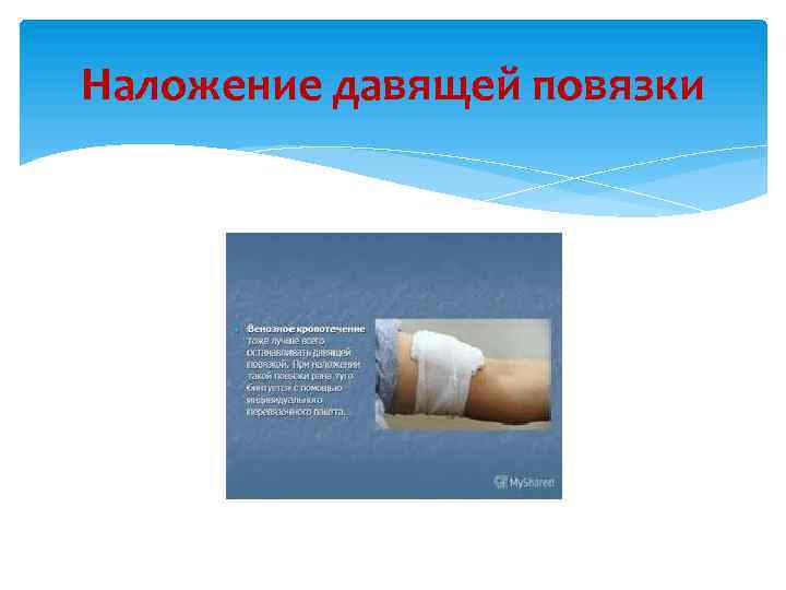 Наложение давящей повязки 
