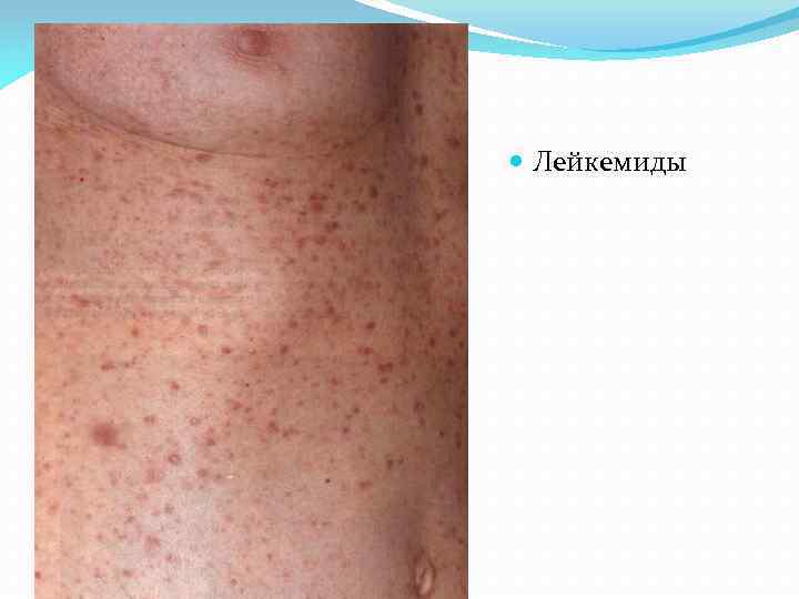  Лейкемиды 