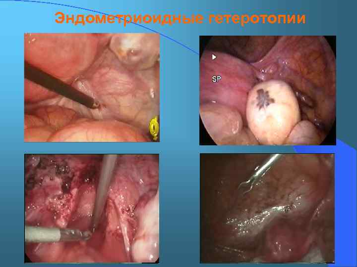 Эндометриоидные гетеротопии 