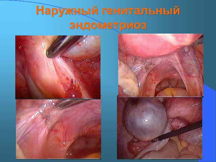 Наружный генитальный эндометриоз 