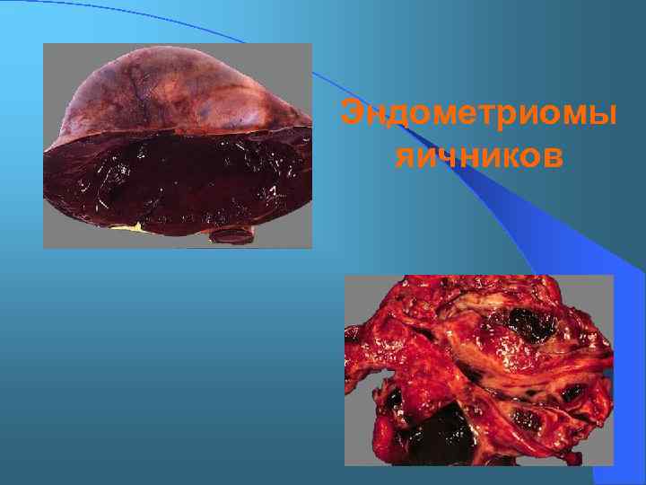 Эндометриомы яичников 