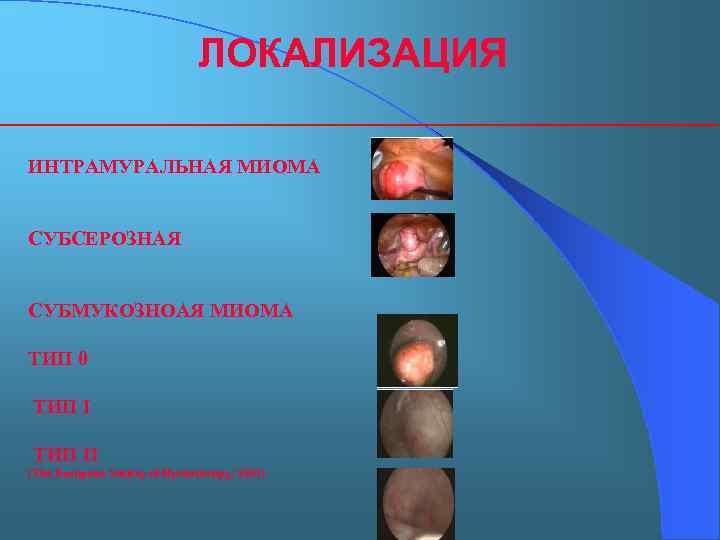 ЛОКАЛИЗАЦИЯ ИНТРАМУРАЛЬНАЯ МИОМА СУБСЕРОЗНАЯ СУБМУКОЗНОАЯ МИОМА ТИП 0 ТИП II (The European Society of