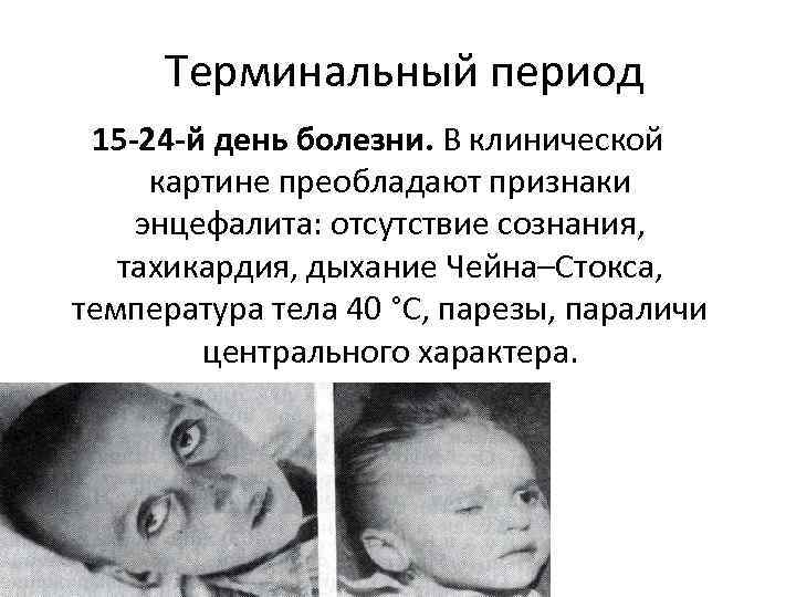 Терминальный период 15 -24 -й день болезни. В клинической картине преобладают признаки энцефалита: отсутствие