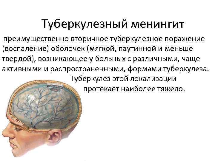 Туберкулезный менингит преимущественно вторичное туберкулезное поражение (воспаление) оболочек (мягкой, паутинной и меньше твердой), возникающее