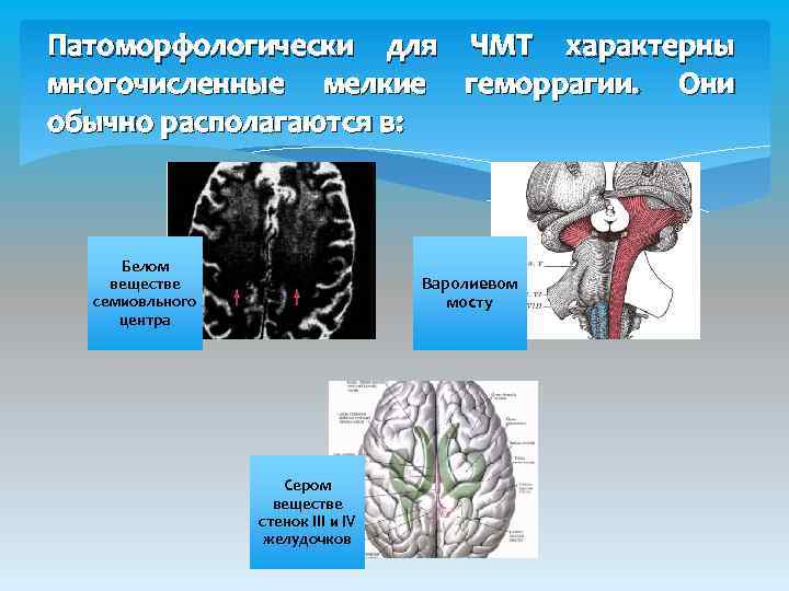 Патоморфологически для ЧМТ характерны многочисленные мелкие геморрагии. Они обычно располагаются в: Белом веществе семиовльного