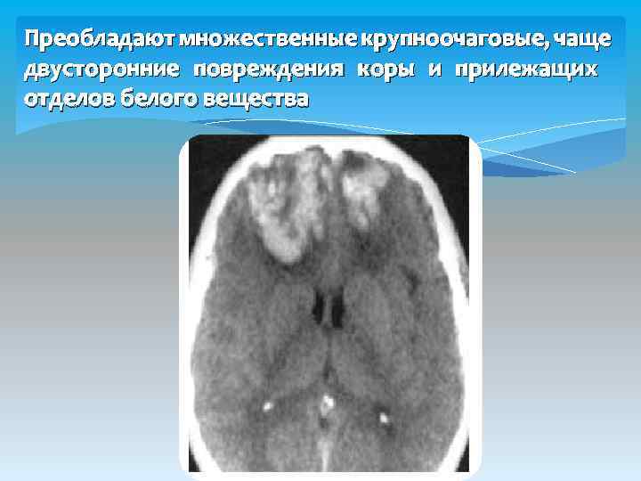 Преобладают множественные крупноочаговые, чаще двусторонние повреждения коры и прилежащих отделов белого вещества 