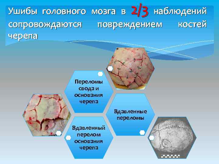 Ушибы головного мозга в 2/3 наблюдений сопровождаются повреждением костей черепа Переломы свода и основания