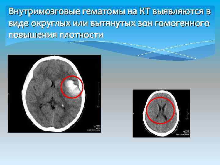 Внутримозговые гематомы на КТ выявляются в виде округлых или вытянутых зон гомогенного повышения плотности