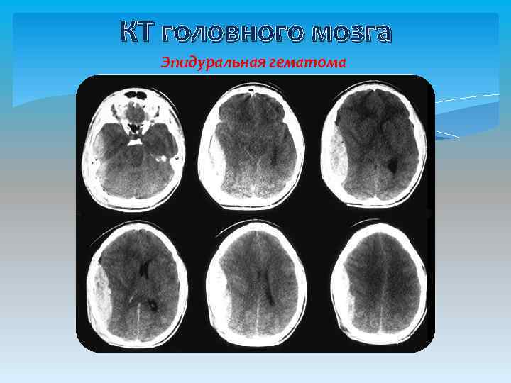 КТ головного мозга Эпидуральная гематома 