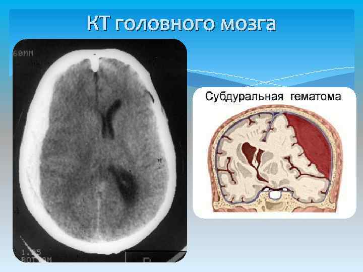 КТ головного мозга 