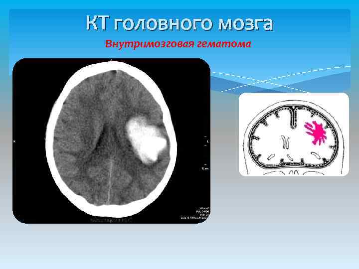 КТ головного мозга Внутримозговая гематома 