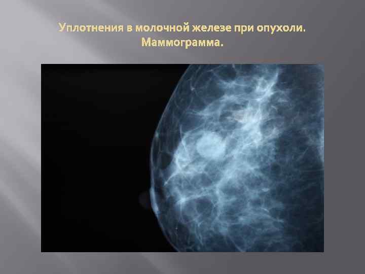 Уплотнения в молочной железе при опухоли. Маммограмма. 