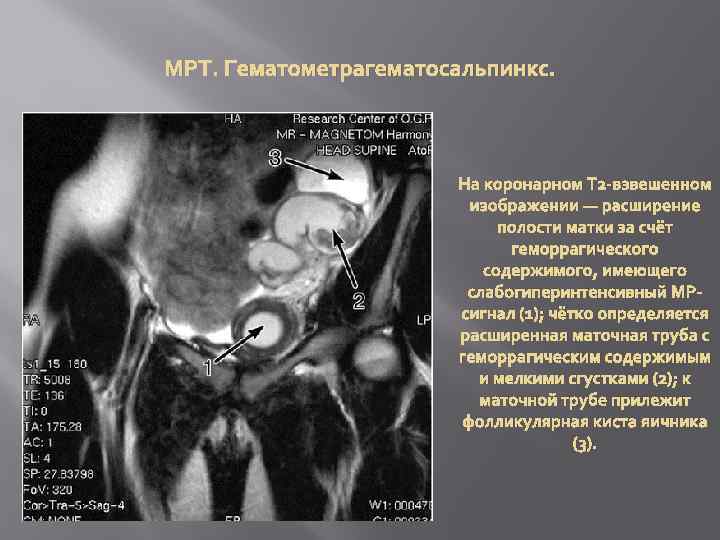 МРТ. Гематометрагематосальпинкс. На коронарном Т 2 -взвешенном изображении — расширение полости матки за счёт