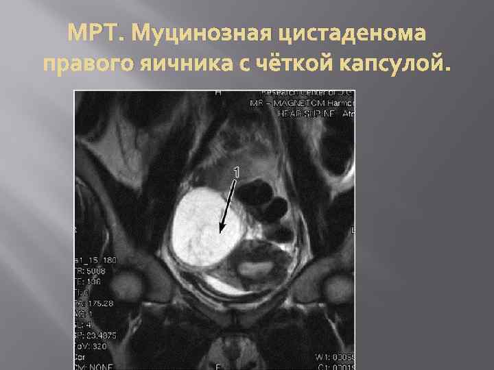 МРТ. Муцинозная цистаденома правого яичника с чёткой капсулой. 