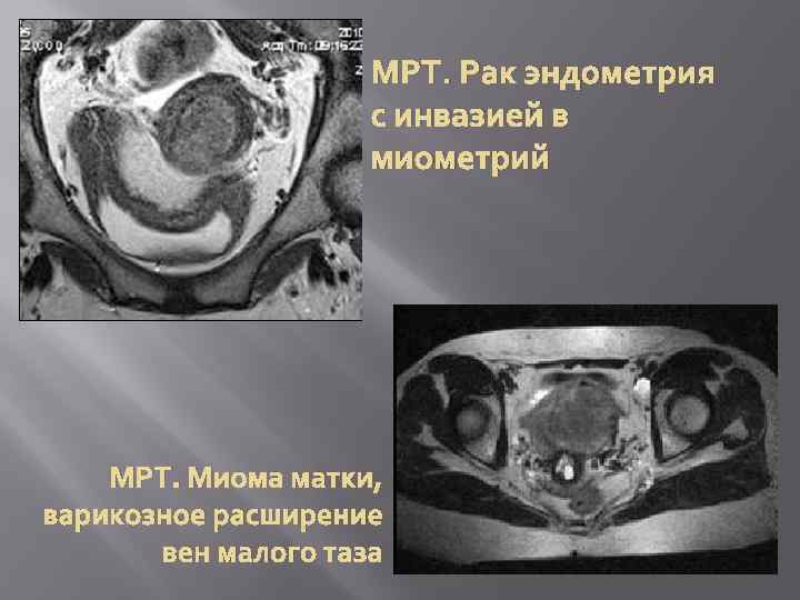 МРТ. Рак эндометрия с инвазией в миометрий МРТ. Миома матки, варикозное расширение вен малого