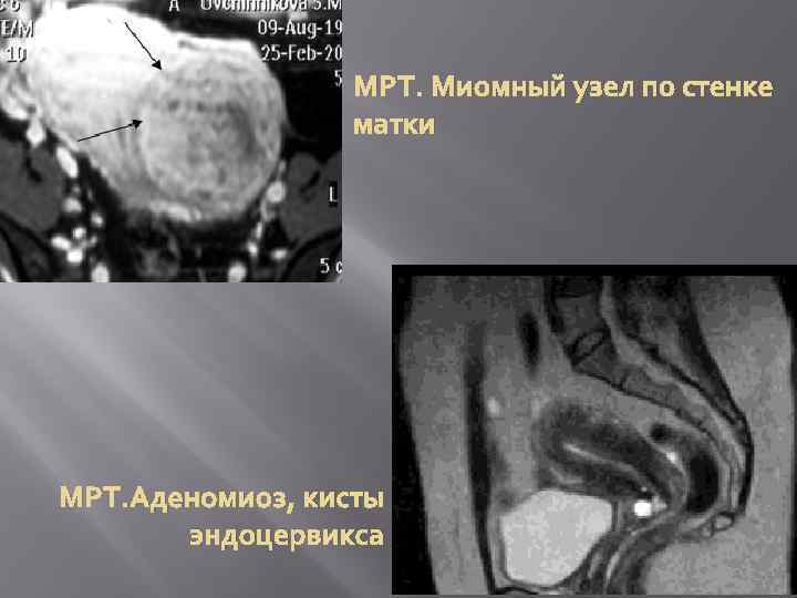 МРТ. Миомный узел по стенке матки МРТ. Аденомиоз, кисты эндоцервикса 