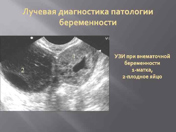 Лучевая диагностика патологии беременности УЗИ при внематочной беременности 1 -матка, 2 -плодное яйцо 