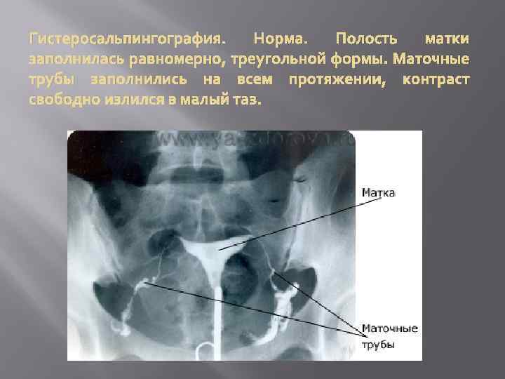 Гистеросальпингография. Норма. Полость матки заполнилась равномерно, треугольной формы. Маточные трубы заполнились на всем протяжении,