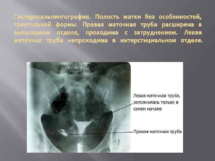 Гистеросальпингография. Полость матки без особенностей, треугольной формы. Правая маточная труба расширена в ампулярном отделе,