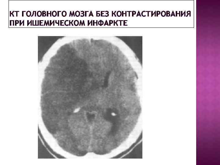 КТ ГОЛОВНОГО МОЗГА БЕЗ КОНТРАСТИРОВАНИЯ ПРИ ИШЕМИЧЕСКОМ ИНФАРКТЕ 