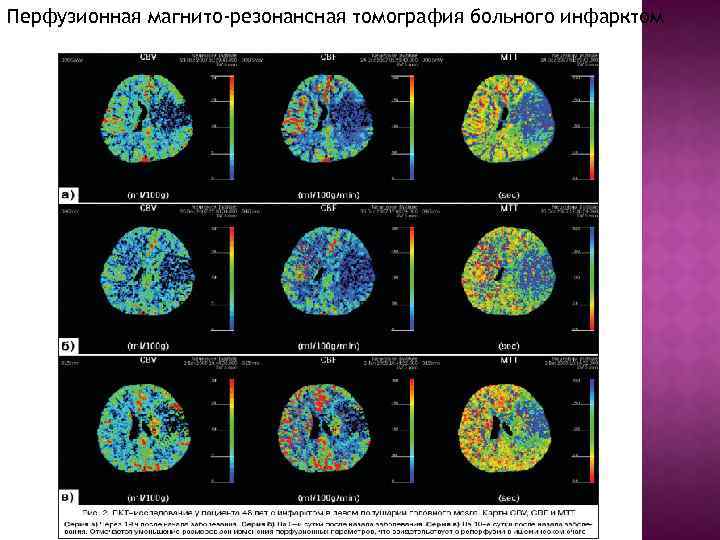 Перфузионная магнито-резонансная томография больного инфарктом 