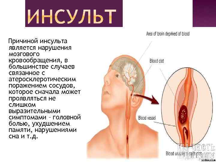 Причиной инсульта является нарушения мозгового кровообращения, в большинстве случаев связанное с атеросклеротическим поражением сосудов,