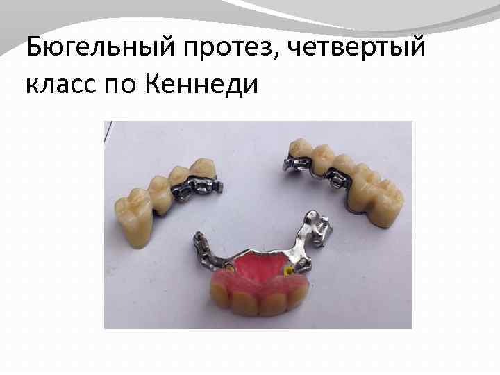 Бюгельные протезы презентация