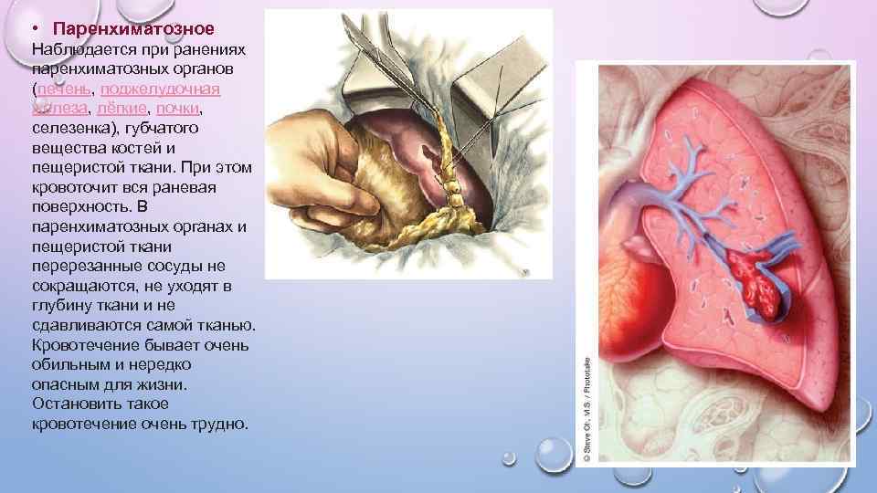  • Паренхиматозное Наблюдается при ранениях паренхиматозных органов (печень, поджелудочная железа, лёгкие, почки, селезенка),