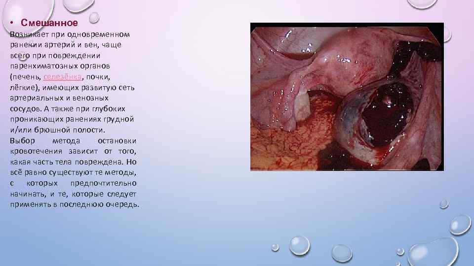  • Смешанное Возникает при одновременном ранении артерий и вен, чаще всего при повреждении
