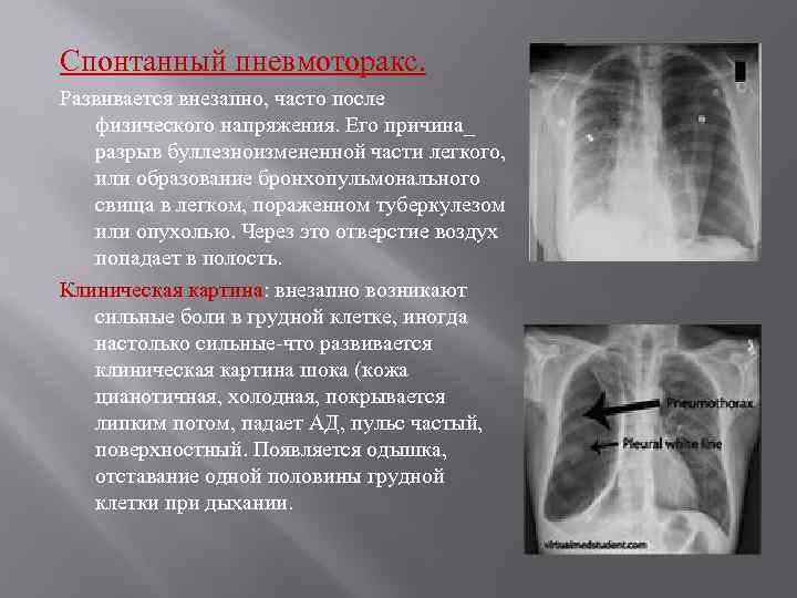 После разрыва легкого. Спонтанный пневмоторакс клинические рекомендации 2020. Правосторонний пневмоторакс рентген. Спонтанный пневмоторакс туберкулез. Спонтанный парциальный пневмоторакс.
