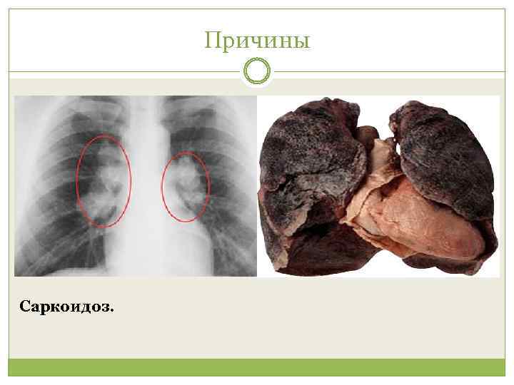 Причины Саркоидоз. 