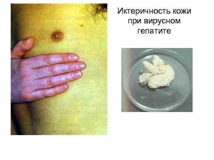 Иктеричность кожи при вирусном гепатите 