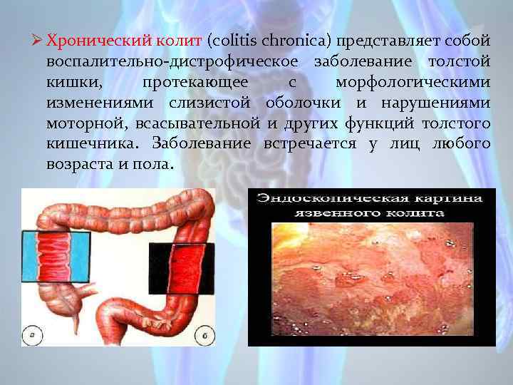 Ø Хронический колит (colitis chronica) представляет собой воспалительно-дистрофическое заболевание толстой кишки, протекающее с морфологическими