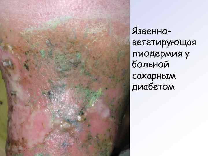 Язвенновегетирующая пиодермия у больной сахарным диабетом 