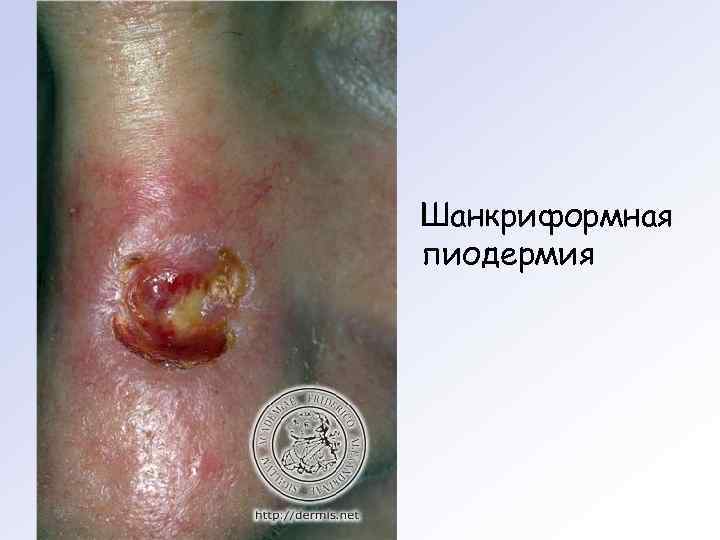 Шанкриформная пиодермия 