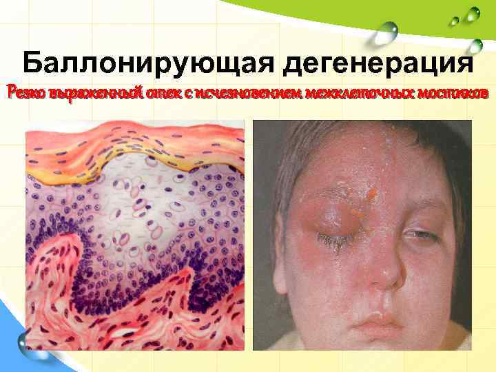 Баллонирующая дегенерация Резко выраженный отек с исчезновением межклеточных мостиков 