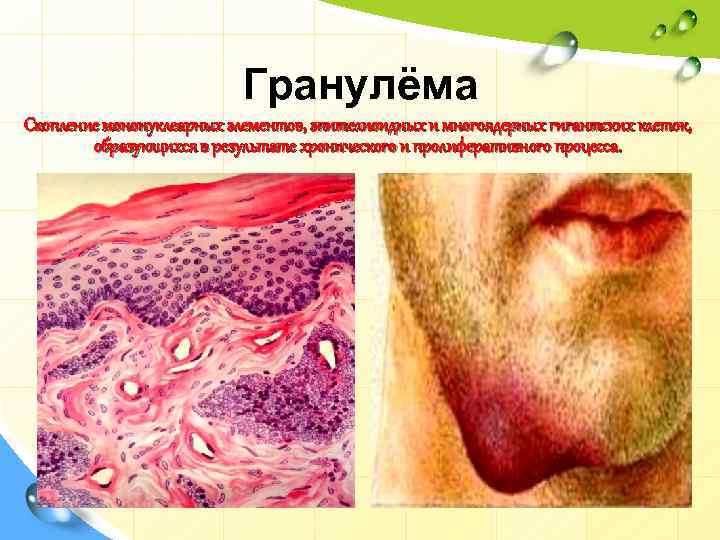 Гранулёма Скопление мононуклеарных элементов, эпителиоидных и многоядерных гигантских клеток, образующихся в результате хронического и